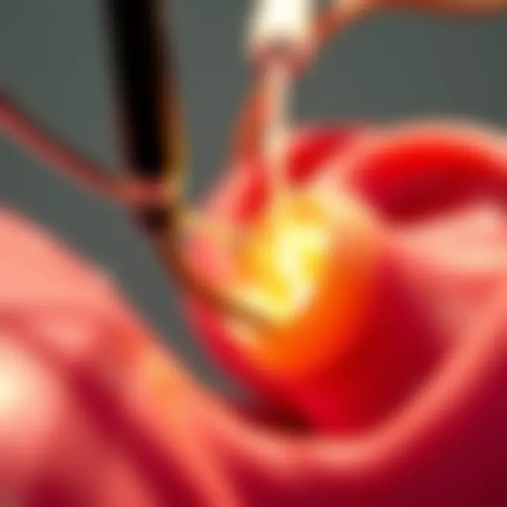 Illustration of catheter ablation technique for atrial fibrillation