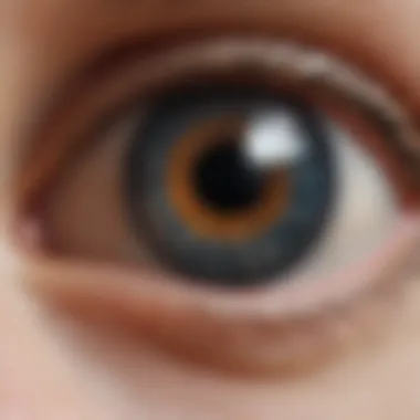 Corneal Abrasion Close-Up Close-up of an eye with visible corneal abrasion